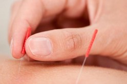 الوخز بالإبر يساعد كبار السن في تفادي تدهور الذاكرة