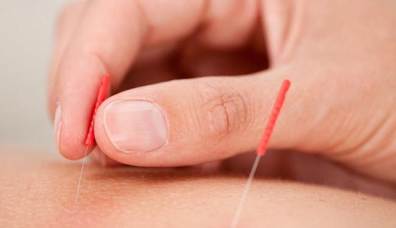 الوخز بالإبر يساعد كبار السن في تفادي تدهور الذاكرة