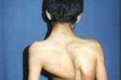 أزيد من 300 مصاب بداء السكليوز  ينتظرون التكفل بهم في البليدة