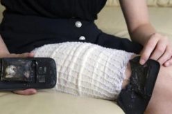 بالصور : انفجار جالاكسي إس 4 في جيب فتاة يتسبب لها في حروق عميقة