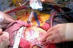 نجاح عملية جراحة  قسطرة شرايين القلب في البليدة