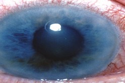 ما يقارب 5 بالمائة من الاشخاص البالغين 40 سنة فما فوق مصابين بمرض الزرق بالجزائر