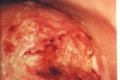 أكثر من 3500 مصابة بسرطان عنق الرحم سنويا بالجزائر