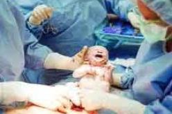 العمليات القيصرية الهدف منها تحقيق الربح السريع