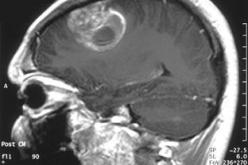 الجزائر عاجزة على التكفل بأورام المخ لدى الكهول