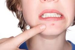 بين 60 الى 70 بالمائة من المراهقين يعانون من حب الشباب