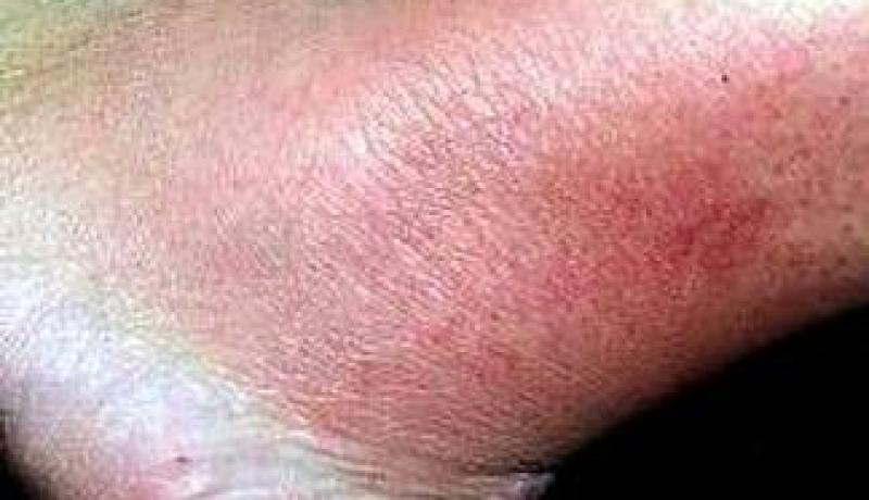 علاج 117 حالة للحمى المالطية ببلدية حساسنة في عين تموشنت