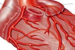 مختصون يدعون انشاء جمعية للمصابين بتصلب الشرايين اللويحي