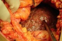 و لا حالة وفاة لدى المتبرعين بالكبد في الجزائر