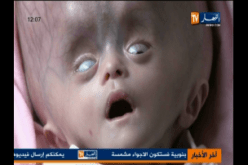 الرضيعة دعاء تعالج في المستشفى بعد نداء عائلتها