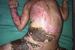 اصابة 5 افراد من عائلة واحدة بحروق اثر انفجار موقد مطبخ بتبسة