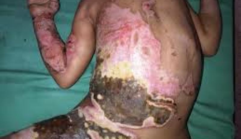 اصابة 5 افراد من عائلة واحدة بحروق اثر انفجار موقد مطبخ بتبسة
