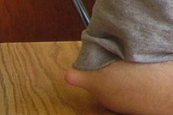 أول عملية ناجحة لاستئصال ورم عظمي بمركز الاستشفاء الجامعي لبجاية