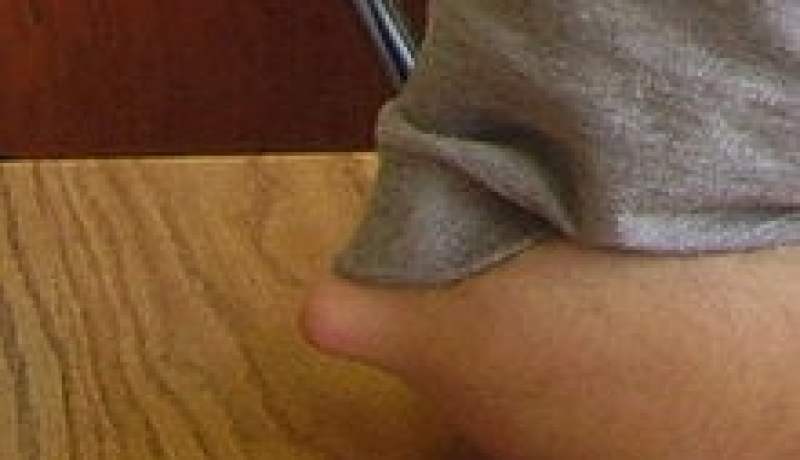 أول عملية ناجحة لاستئصال ورم عظمي بمركز الاستشفاء الجامعي لبجاية