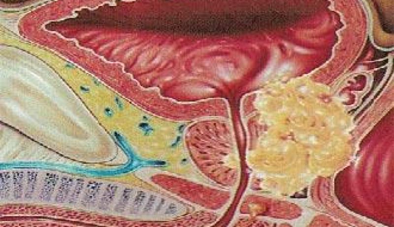 باحثون يبانيون يتوصلون لعلاج سرطان البروستات