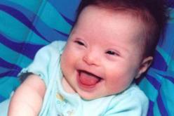 من 80 الى 90 الف مصاب  بالتثلث الصبغي في الجزائر