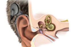 زرع قوقعات الأذن لطفلين يعانيان من الصمم بالمستشفى الجامعي لوهران