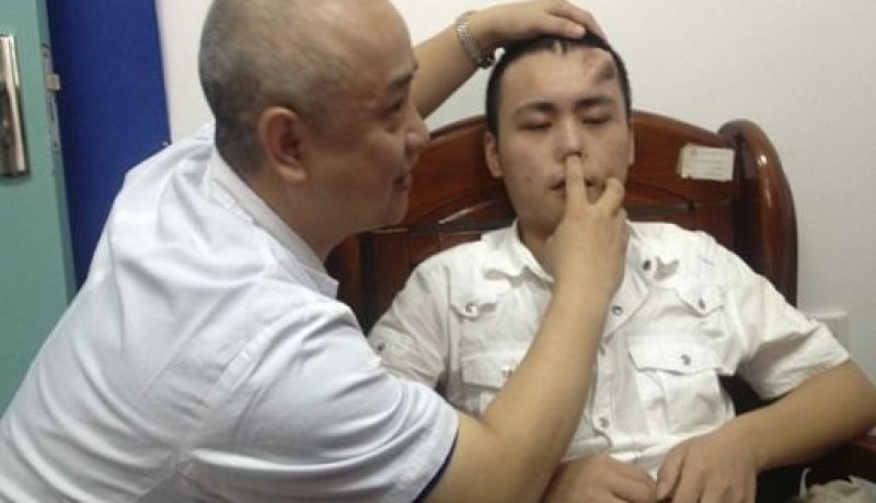 جراحون صينيون ينجحون في زراعة أنف في جبين شاب صيني