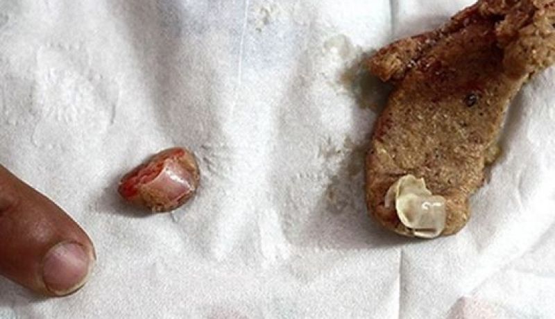إصبع بشري داخل قطعة مأكولة burger