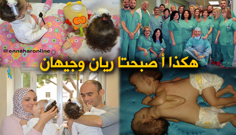 فصل توأمين جزائريين بمستشفى روما بإيطاليا