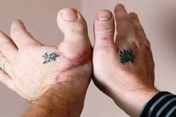 نجّار فقد إبهامه فاستبدله بأصبع القدم