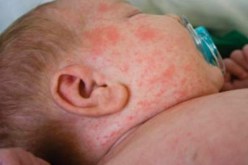 الاشتباه في 100 حالة إصابة بداء “البوحمرون” في جيجل