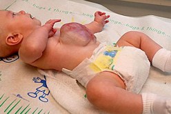 طفل‮ ‬يولد بمعدته وأمعائه خارج بطنه‮ ‬