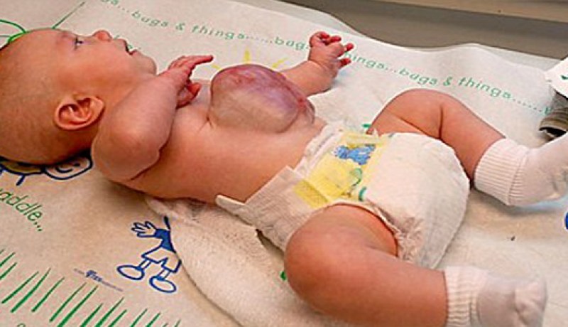 طفل‮ ‬يولد بمعدته وأمعائه خارج بطنه‮ ‬