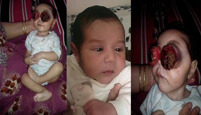 وزير الصحة يتكفل بحالة الرضيع ابراهيم مؤيد جبار الفاقد لعينيه بتاجنانت في ميلة