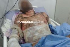 امرأة تحرق زوجها «الماصو» بالبنزين داخل المنزل بعد خلافات بينهما !