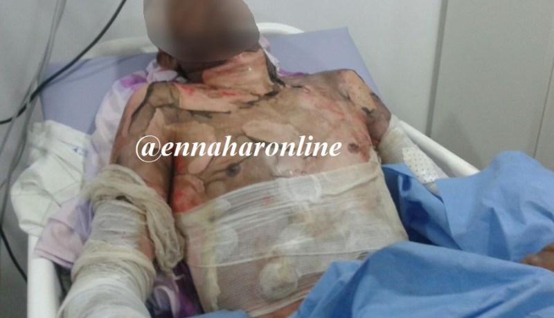 امرأة تحرق زوجها «الماصو» بالبنزين داخل المنزل بعد خلافات بينهما !