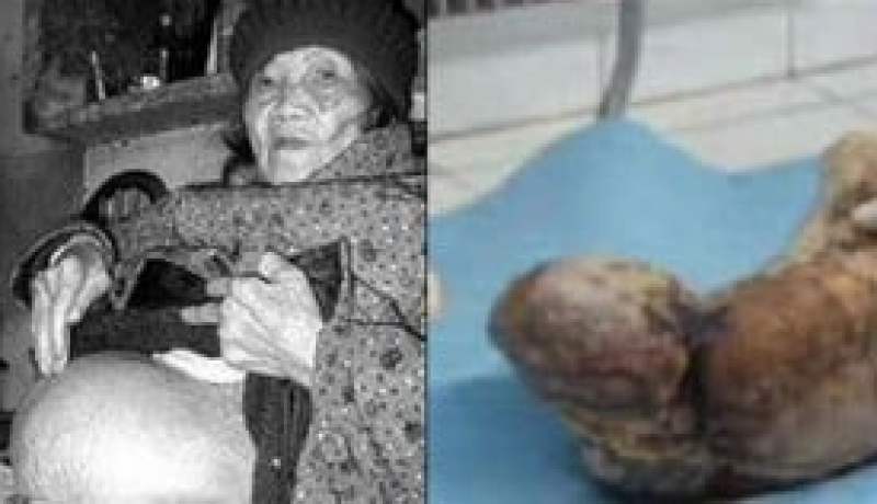 عجوز تضع مولودا في 92 من عمرها