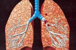 تغيرات جينية تضاعف مخاطر إصابة غير المدخنين بسرطان الرئة