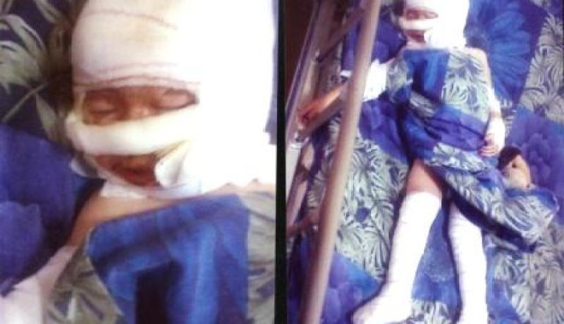 وفاة الصغيرة ''مروى'' أمس بعيادة خاصة بالعاصمة متأثرة بحروقها
