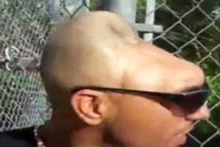 المخدرات تحول أمريكي إلى رجل بنصف رأس