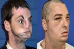 إستبدال وجه كامل في عملية تجميلية إستغرقت 36 ساعة