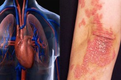 مرضى الصدفية أكثر عرضة للإصابة بأمراض القلب