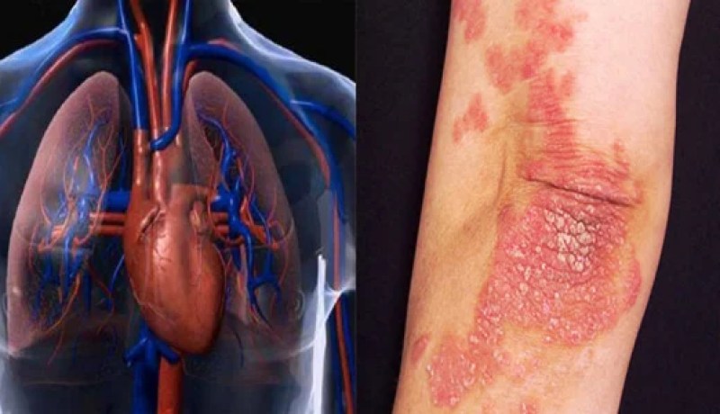 مرضى الصدفية أكثر عرضة للإصابة بأمراض القلب