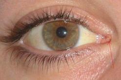 جاءت لعلاج حروقها ففقدت عينها في مستشفى تلمسان!