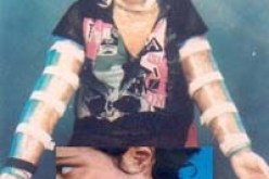 أضرم فيها زوجها النار و تسبب لها في معاناة لا تنتهي