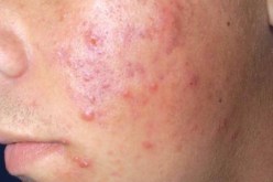 مستخلصات حليب الأم وزيت جوز الهند يقضي على مرض حب الشباب