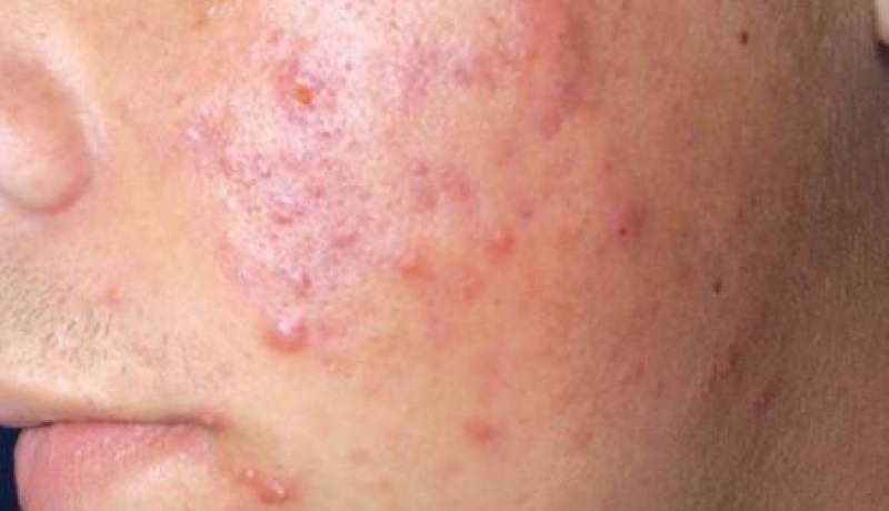 مستخلصات حليب الأم وزيت جوز الهند يقضي على مرض حب الشباب