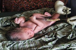 أبحاث لاستخدام خلايا من الحبل السري لمعالجة صمم الرضع