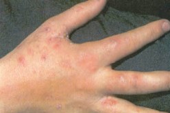 مختصون يؤكدون ضرورة فتح دور تتكفل بالتهاب الجلد التأتبي لدى الاطفال