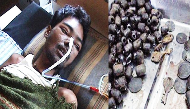 استخراج ‮6 ‬كيلوغرام من الحديد من معدة هندي