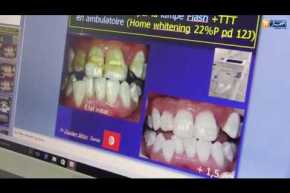 صحة: التصبغ وبروز الفك العلوي.. هذه هي طبيعة أسنان الجزائريين