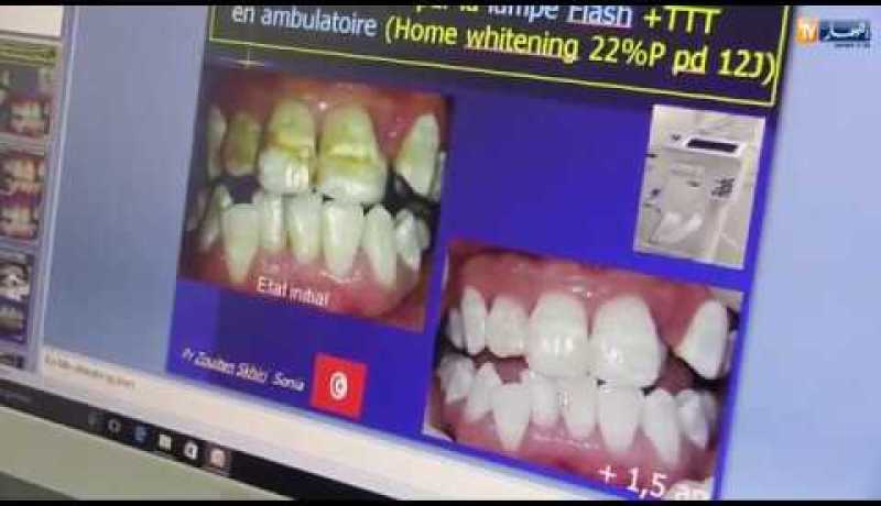 صحة: التصبغ وبروز الفك العلوي.. هذه هي طبيعة أسنان الجزائريين