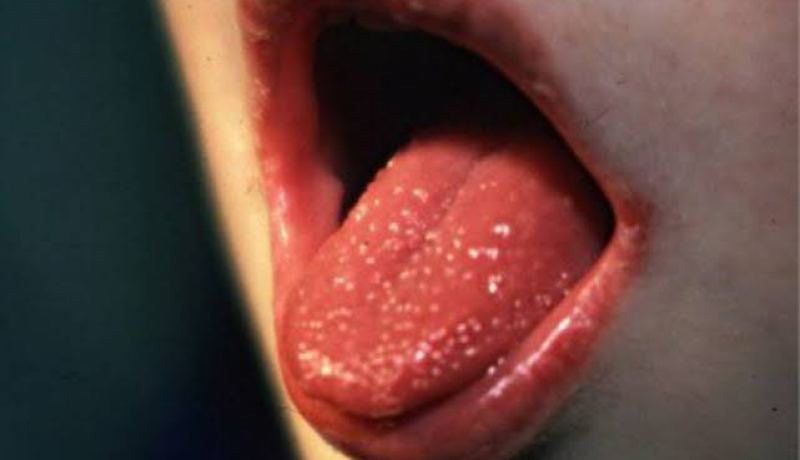 رئيس اتحاد الأطباء الجزائريين لناحية الشرق: كاوازاكي مرض نادر وله علاج