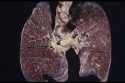 علماء يجدون ان الأوكسجين قد يسبب سرطان الرئة