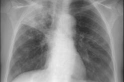 الفقر هو سبب إنتشار مرض السل ويصيب الأطفال لعدم تلقيحهم بلقاح” BCG” أثناء الولادة